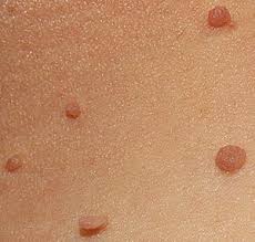 Are Skin Tags an Early Sign of Cancer