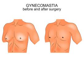 Gynecomastia Symptoms and Treatment