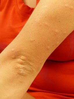 Surprising Reasons You Are Itchy