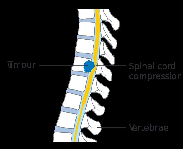 Causes and Treatment of Spinal Cord Compression