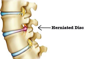 How To Prevent And Treat Herniated Disc