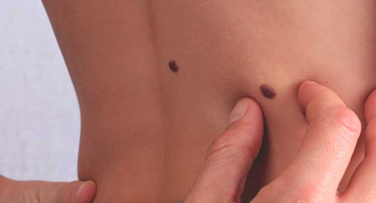 Are Skin Tags an Early Sign of Cancer?