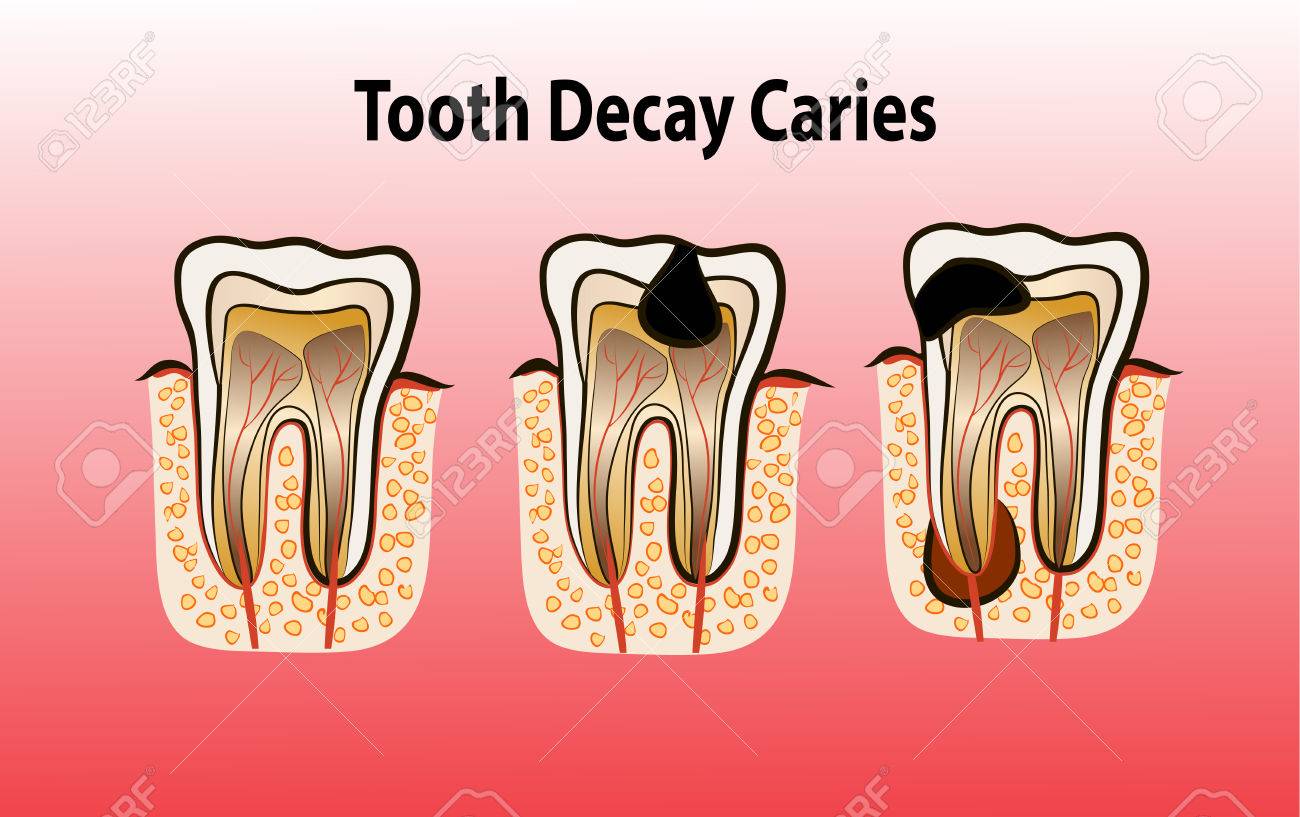 what causes caries